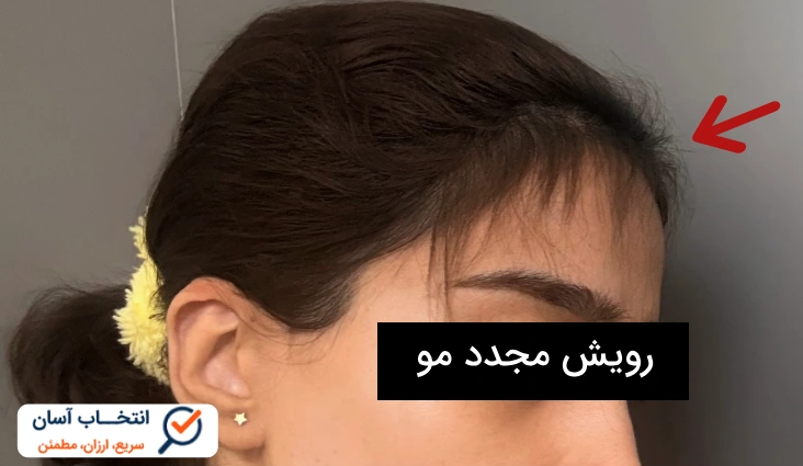 نظرات در مورد ماینوکسیدیل